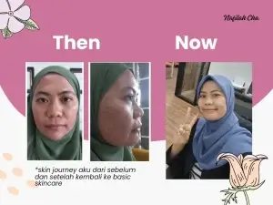 Skin journey Nafilah Cha sebelum dan sesudah kembali ke basic skincare routine